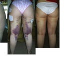 before, week after,2moths after